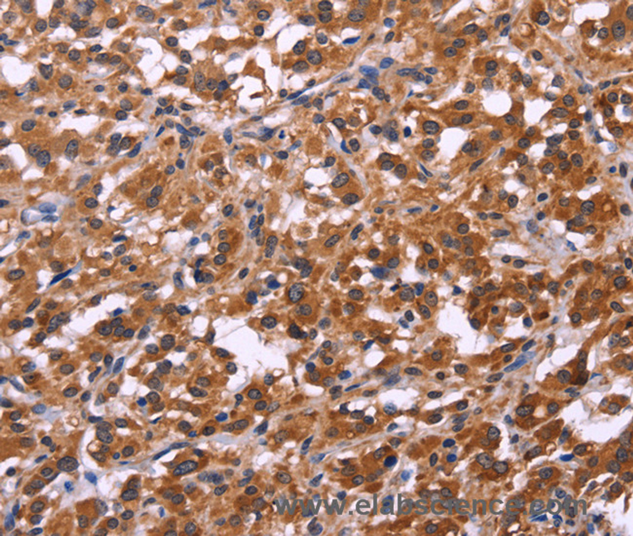 Immunohistochemistry of paraffin-embedded Human thyroid cancer tissue using SPATA7 Polyclonal Antibody at dilution 1:30