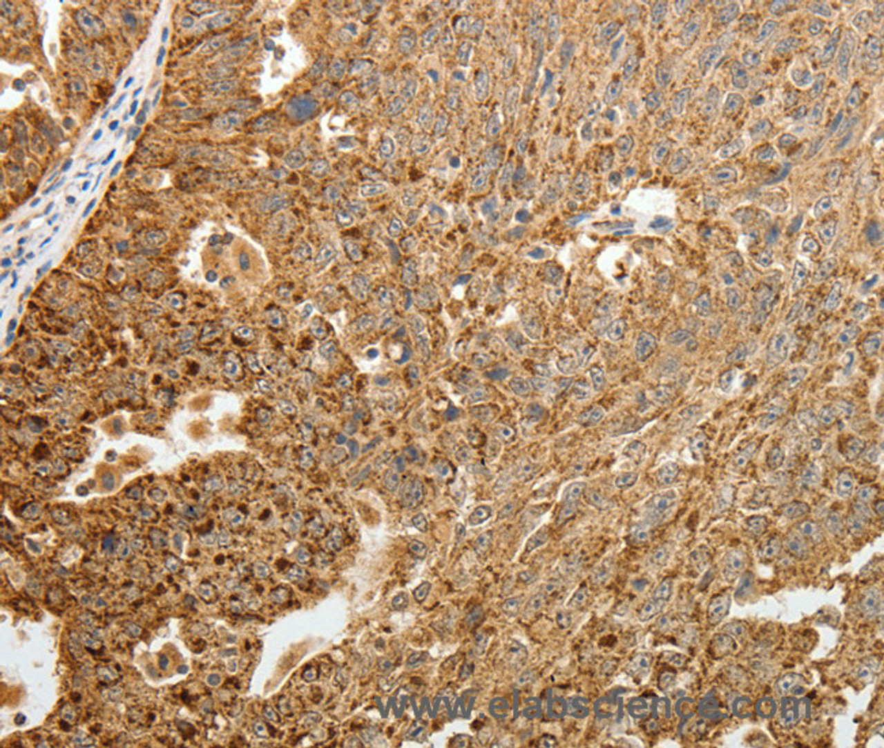 Immunohistochemistry of paraffin-embedded Human ovarian cancer tissue using TFF2 Polyclonal Antibody at dilution 1:40