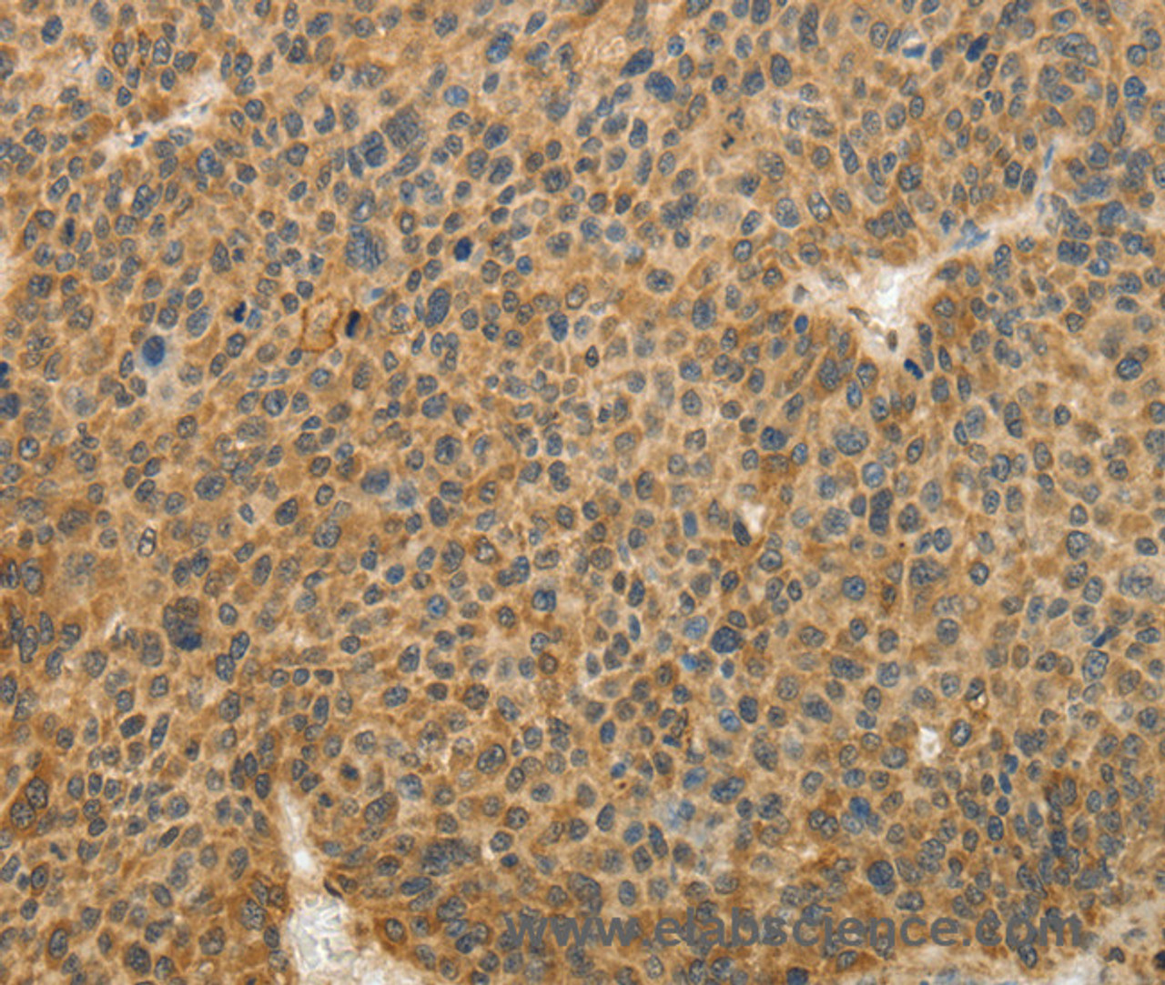 Immunohistochemistry of paraffin-embedded Human liver cancer tissue using TFPI2 Polyclonal Antibody at dilution 1:30