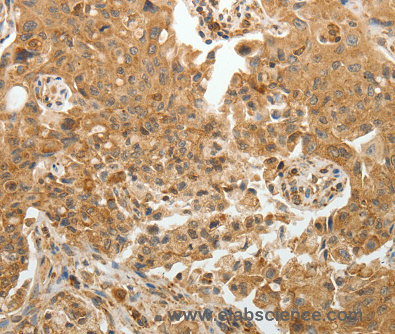 Immunohistochemistry of paraffin-embedded Human lung cancer tissue using TFPI2 Polyclonal Antibody at dilution 1:30