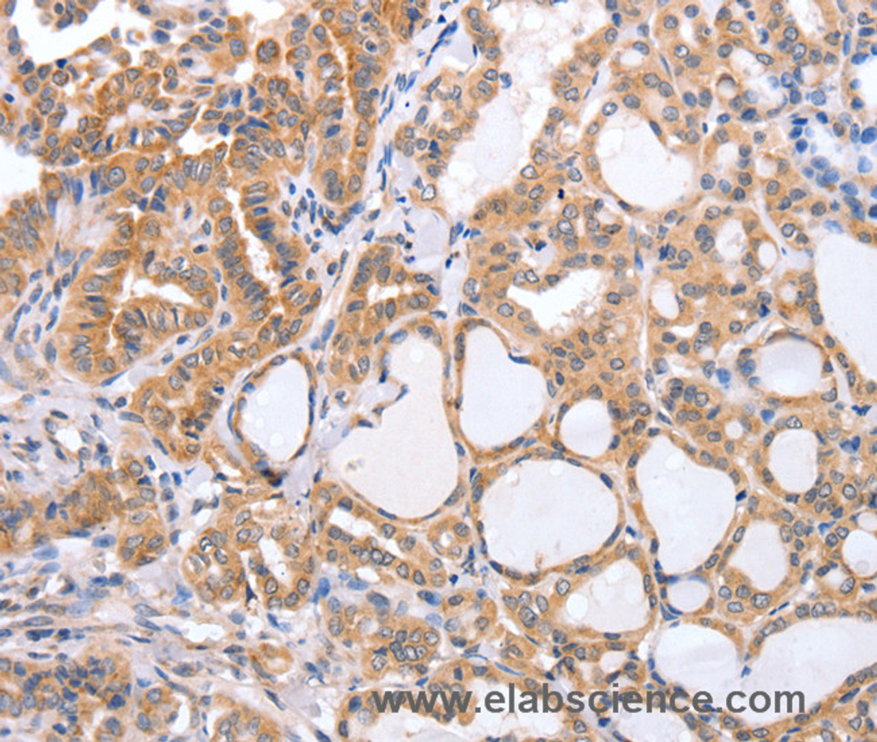 Immunohistochemistry of paraffin-embedded Human thyroid cancer tissue using TGFA Polyclonal Antibody at dilution 1:60