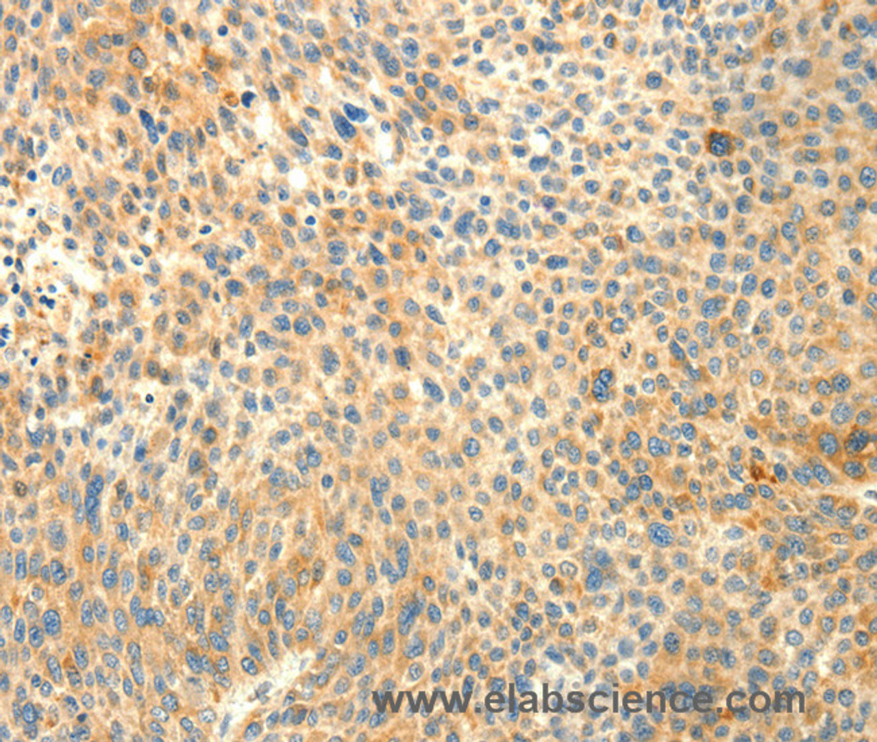 Immunohistochemistry of paraffin-embedded Human liver cancer using TRAF3IP2 Polyclonal Antibody at dilution of 1:30