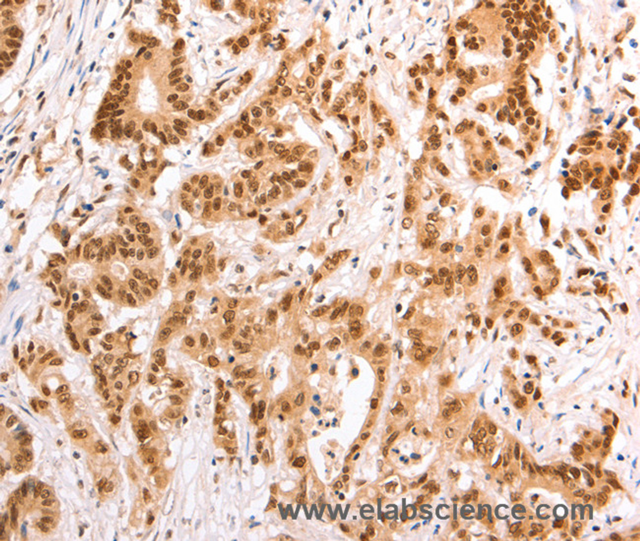 Immunohistochemistry of paraffin-embedded Human colon cancer tissue using TAX1BP1 Polyclonal Antibody at dilution 1:60