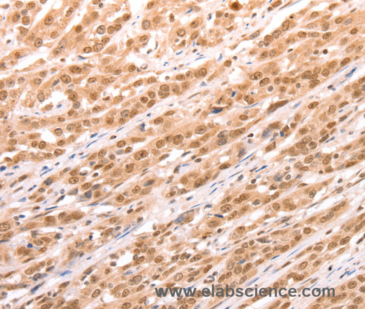 Immunohistochemistry of paraffin-embedded Human esophagus cancer tissue using TAX1BP1 Polyclonal Antibody at dilution 1:60