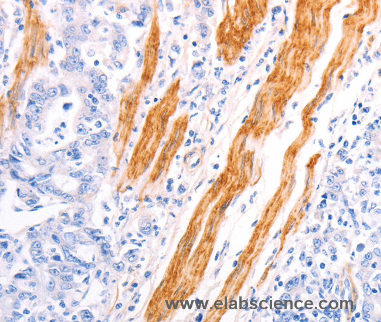 Immunohistochemistry of paraffin-embedded Human gastric cancer using TPM1 Polyclonal Antibody at dilution of 1:40