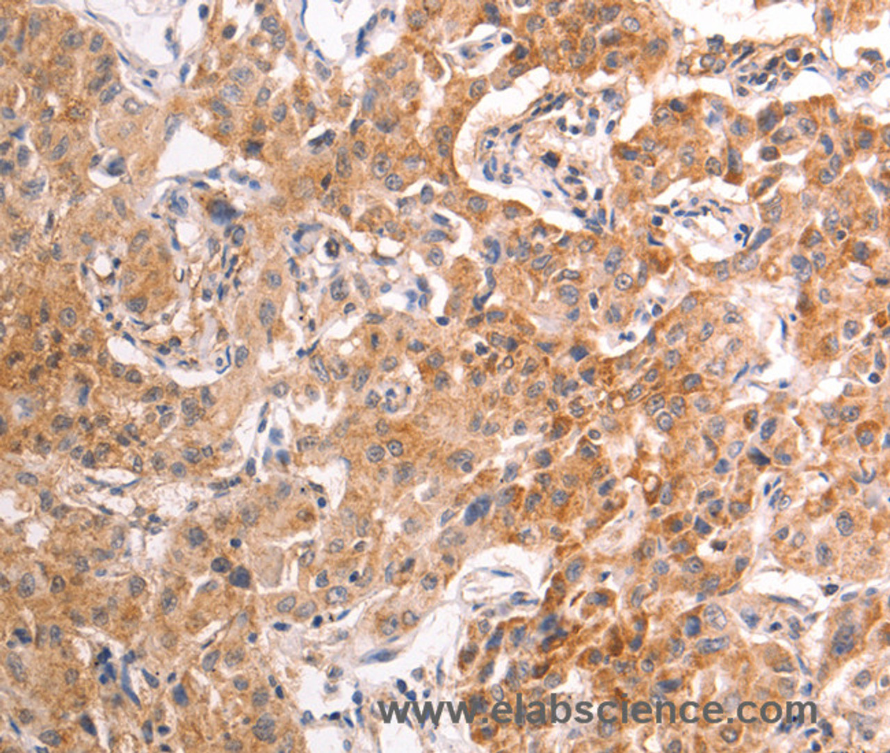 Immunohistochemistry of paraffin-embedded Human liver cancer tissue using TRPV4 Polyclonal Antibody at dilution 1:40