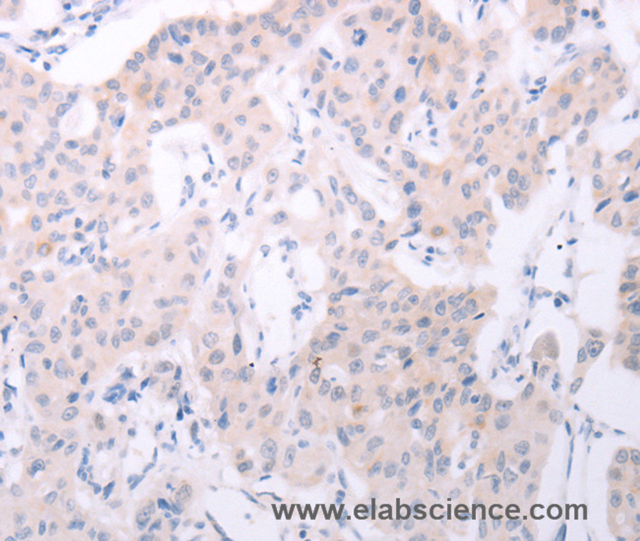 Immunohistochemistry of paraffin-embedded Human lung cancer tissue using SPATA6 Polyclonal Antibody at dilution 1:50