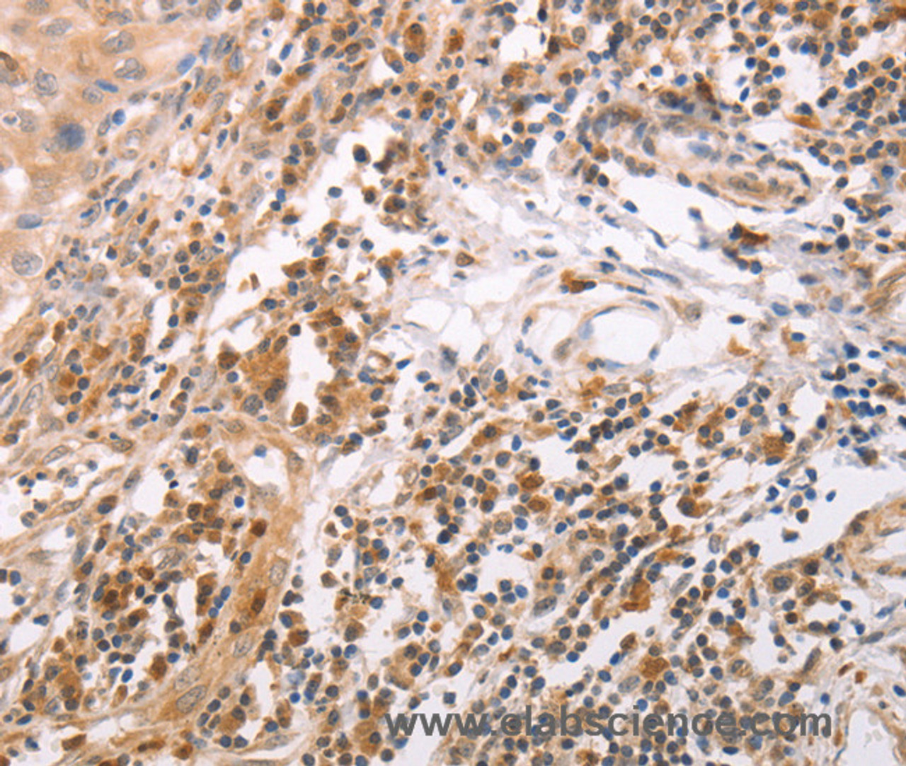 Immunohistochemistry of paraffin-embedded Human cervical cancer tissue using CIDEB Polyclonal Antibody at dilution 1:50