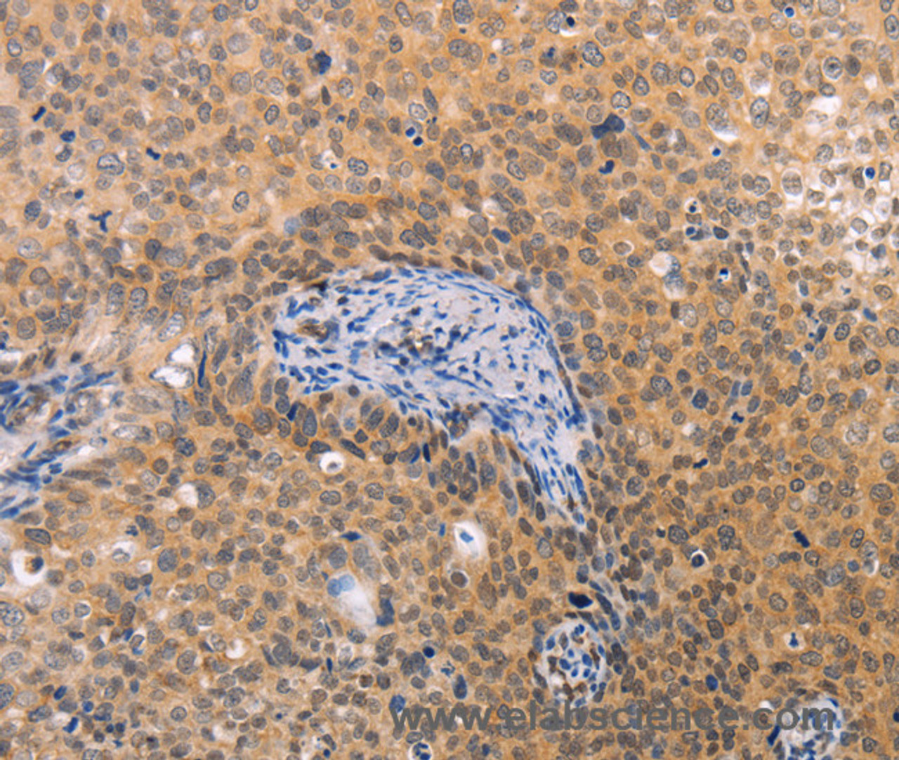 Immunohistochemistry of paraffin-embedded Human cervical cancer tissue using pVHL Polyclonal Antibody at dilution 1:40