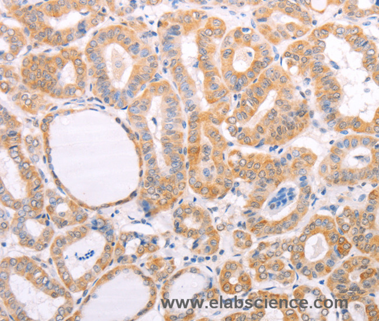 Immunohistochemistry of paraffin-embedded Human thyroid cancer tissue using pVHL Polyclonal Antibody at dilution 1:40