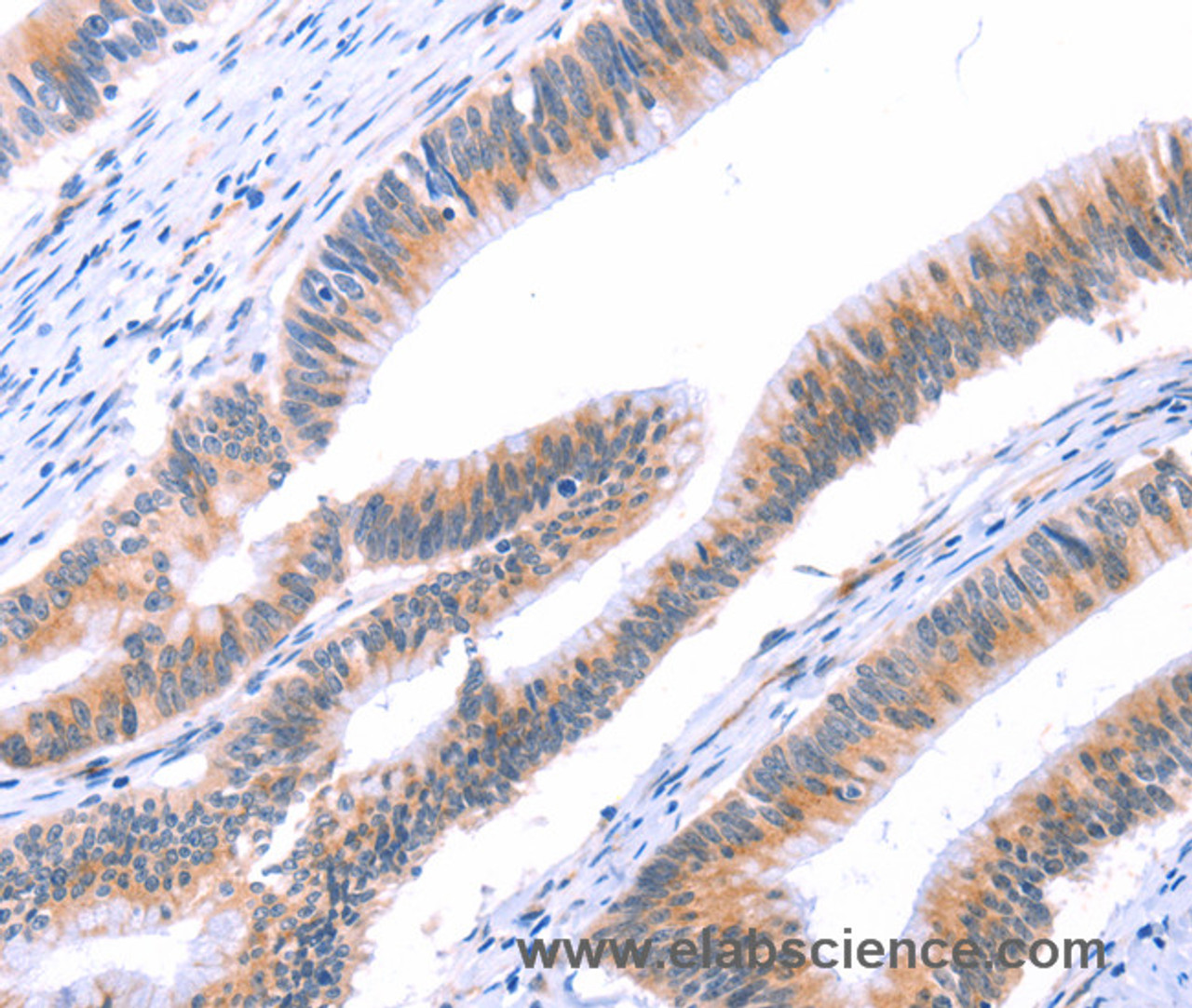 Immunohistochemistry of paraffin-embedded Human colon cancer tissue using VWF Polyclonal Antibody at dilution 1:50