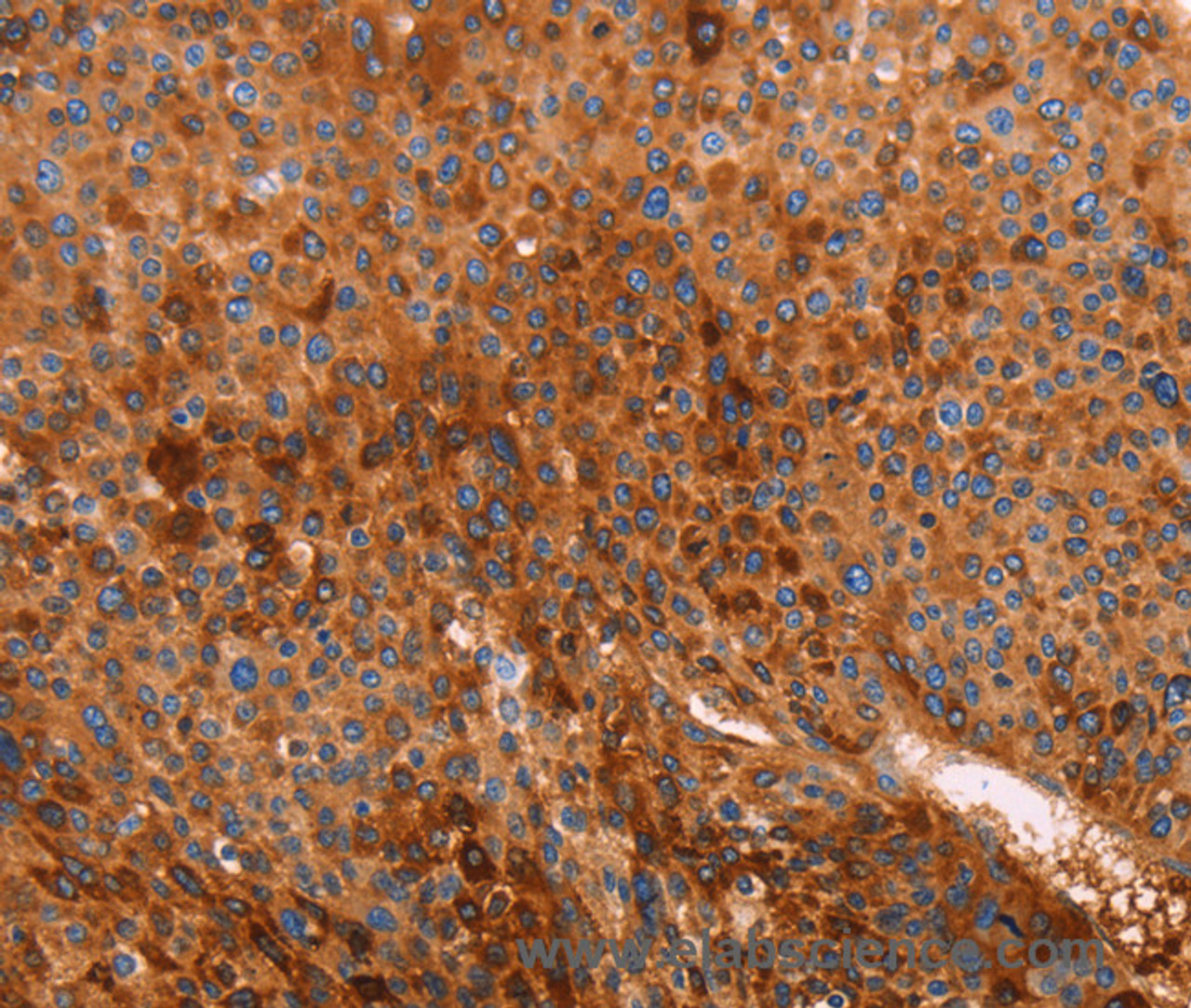 Immunohistochemistry of paraffin-embedded Human liver cancer using GC Polyclonal Antibody at dilution of 1:40