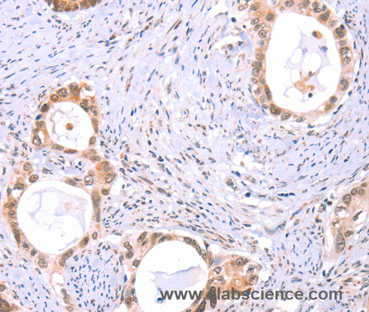 Immunohistochemistry of paraffin-embedded Human cervical cancer tissue using PROS1 Polyclonal Antibody at dilution 1:60