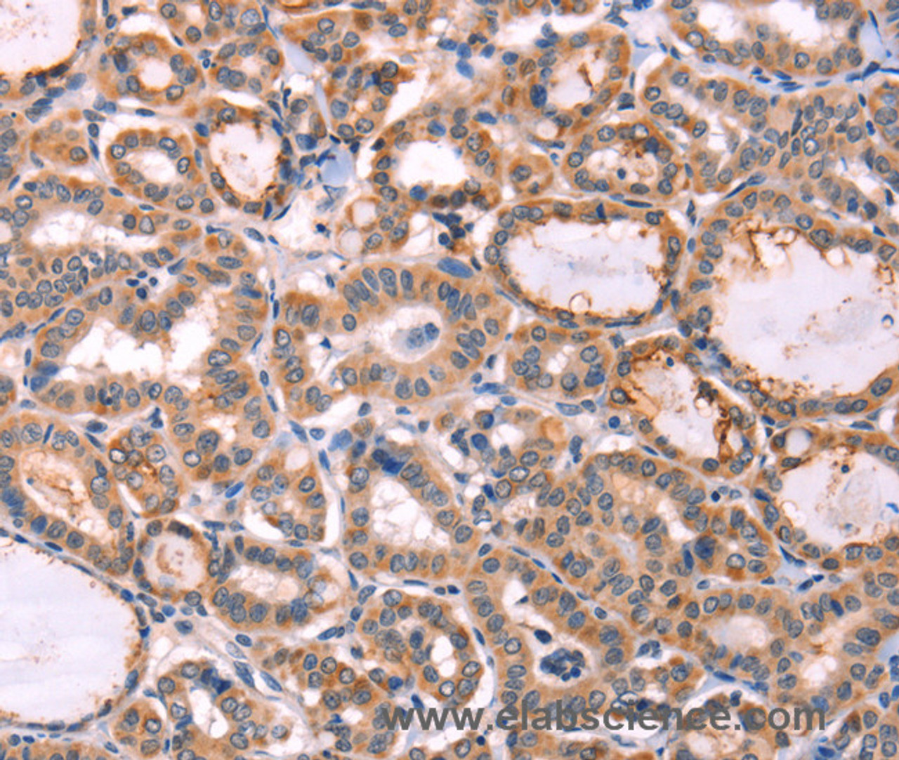 Immunohistochemistry of paraffin-embedded Human thyroid cancer tissue using PROS1 Polyclonal Antibody at dilution 1:60
