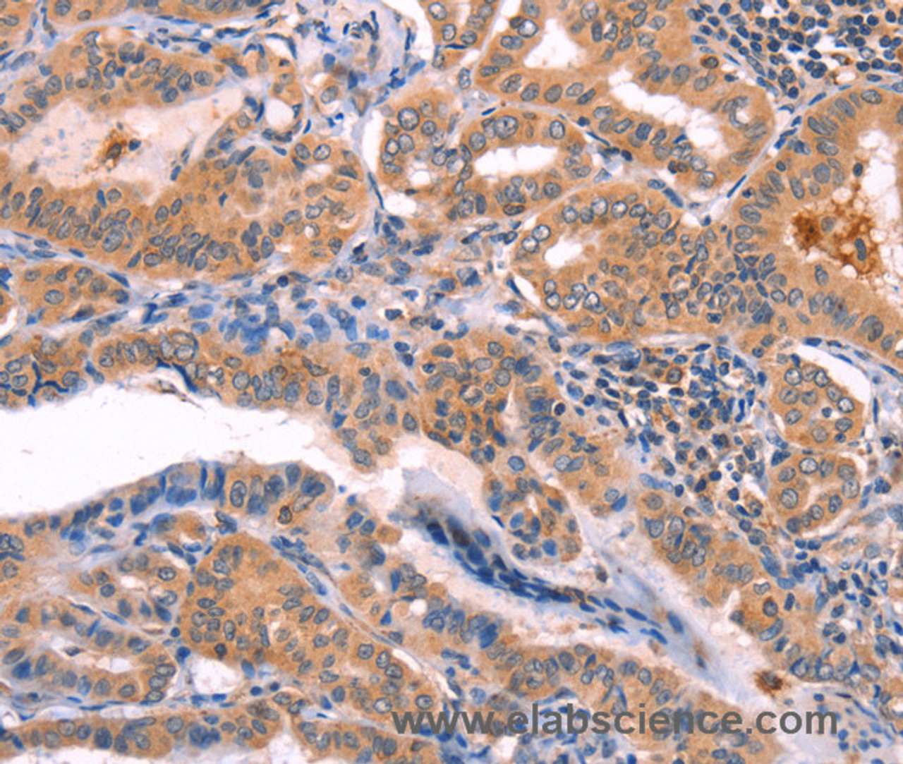 Immunohistochemistry of paraffin-embedded Human thyroid cancer using NCEH1 Polyclonal Antibody at dilution of 1:80