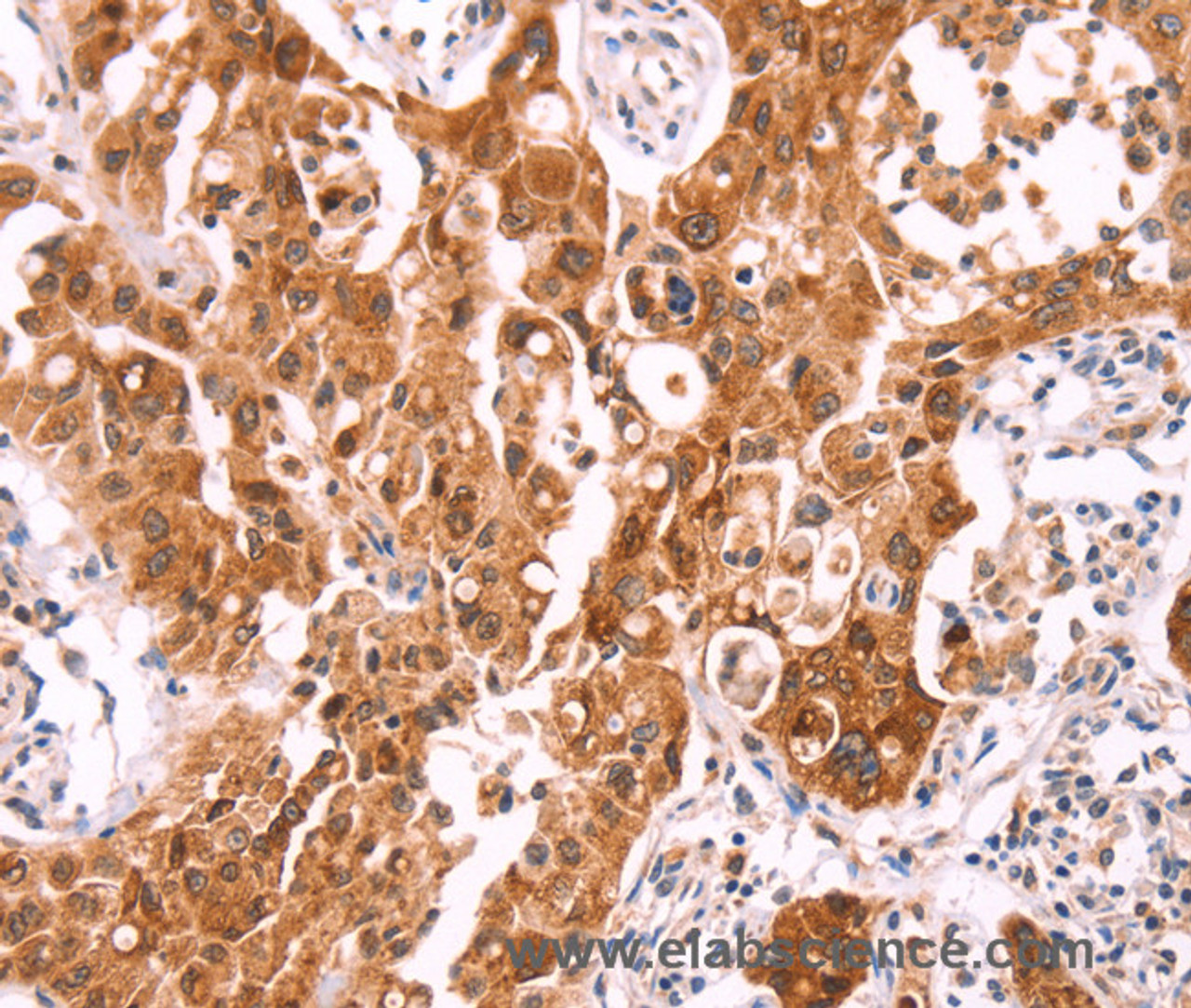 Immunohistochemistry of paraffin-embedded Human lung cancer using NCEH1 Polyclonal Antibody at dilution of 1:80