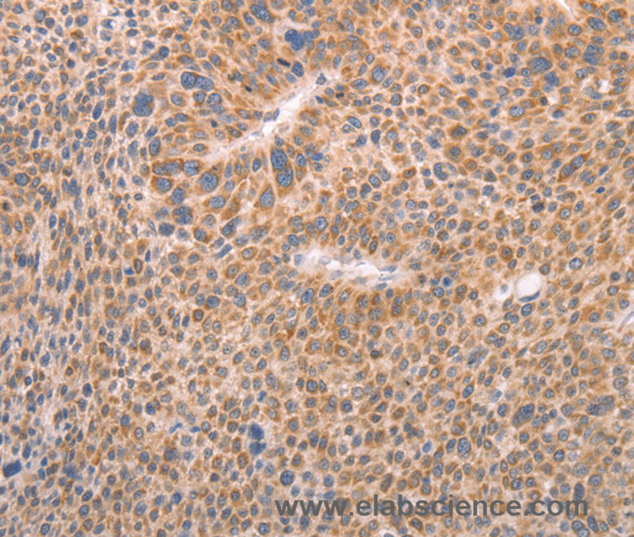 Immunohistochemistry of paraffin-embedded Human liver cancer using AASDHPPT Polyclonal Antibody at dilution of 1:30