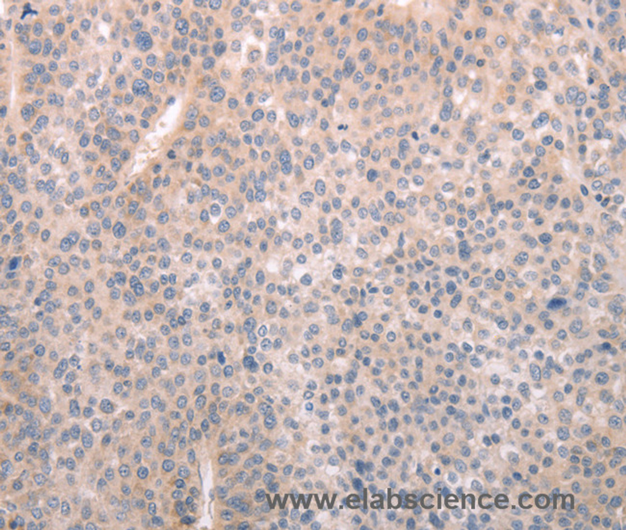 Immunohistochemistry of paraffin-embedded Human liver cancer tissue using ABCF1 Polyclonal Antibody at dilution 1:40