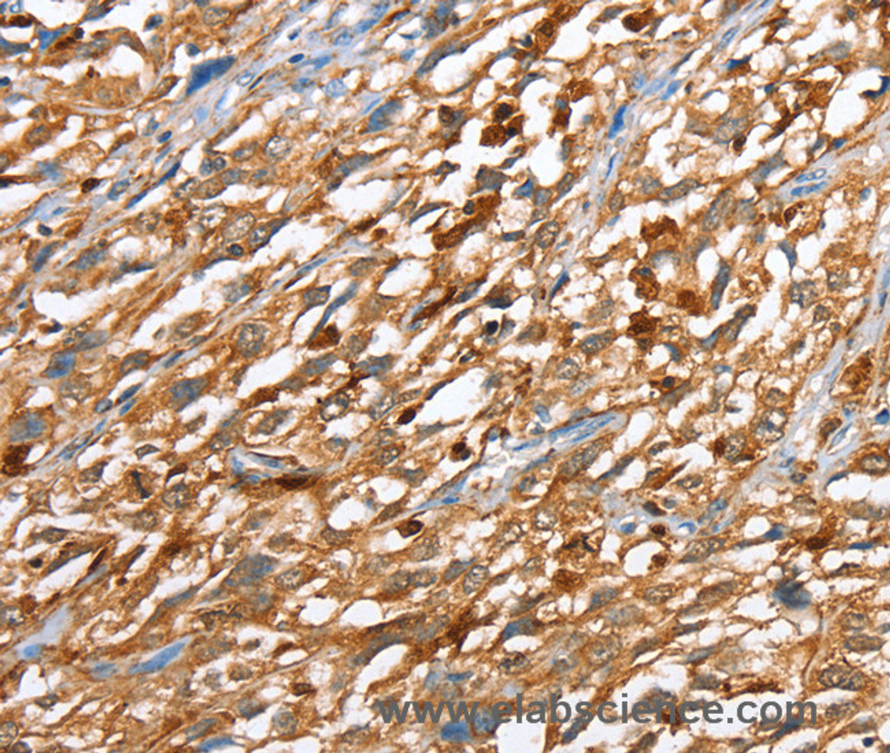 Immunohistochemistry of paraffin-embedded Human esophagus cancer using CAPG Polyclonal Antibody at dilution of 1:40