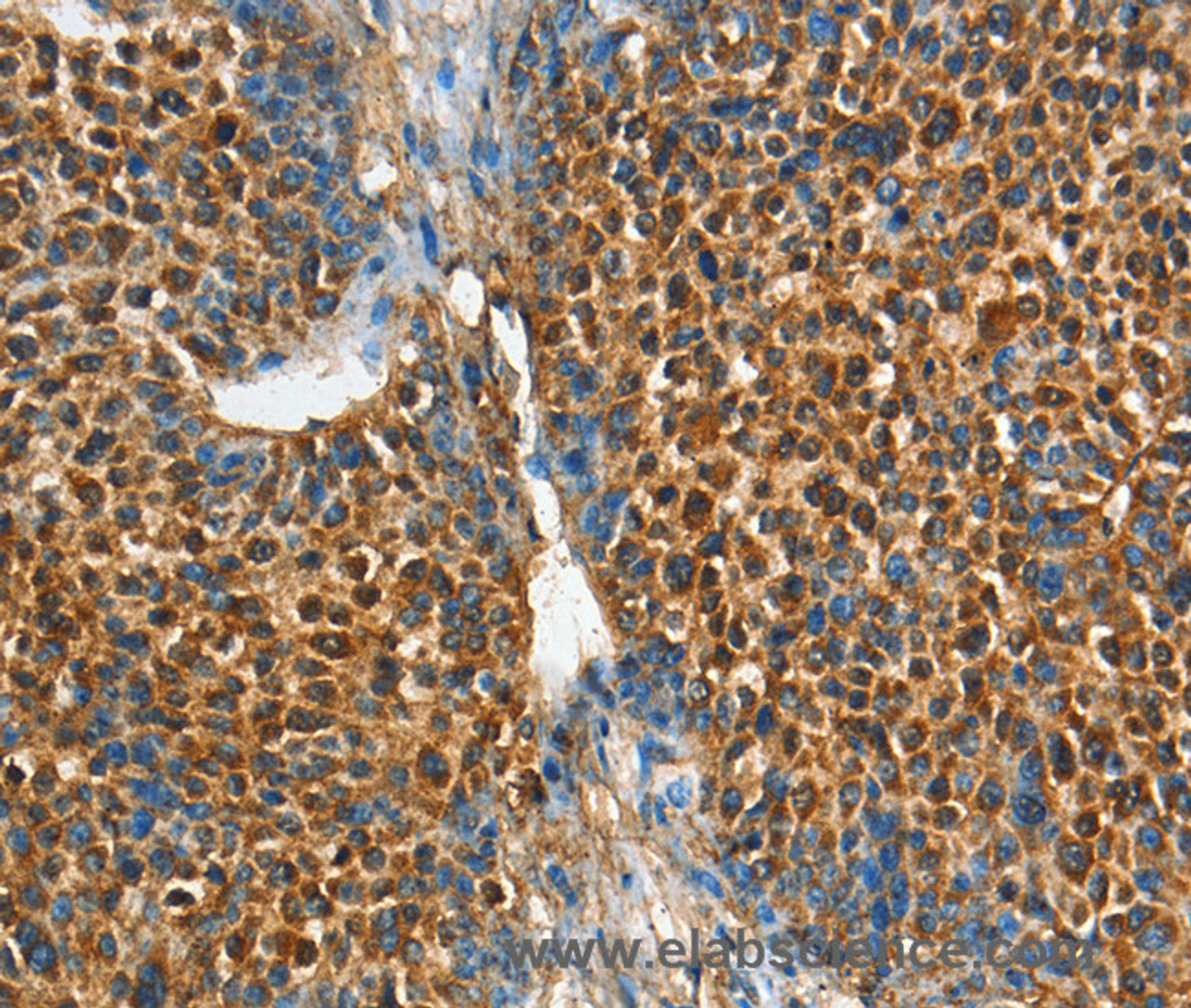 Immunohistochemistry of paraffin-embedded Human liver cancer tissue using ADCY4 Polyclonal Antibody at dilution 1:45