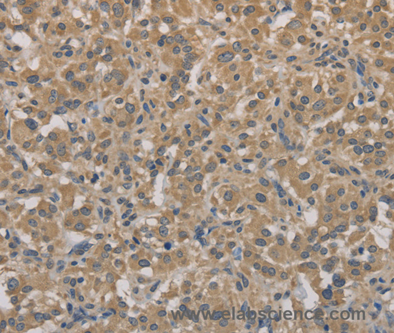 Immunohistochemistry of paraffin-embedded Human thyroid cancer tissue using AGTRAP Polyclonal Antibody at dilution 1:40