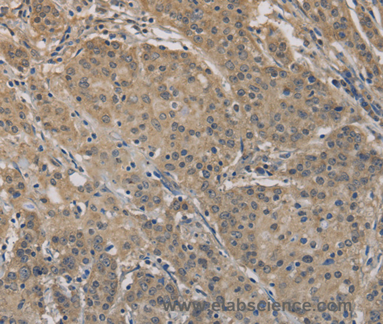 Immunohistochemistry of paraffin-embedded Human gastric cancer tissue using AGTRAP Polyclonal Antibody at dilution 1:40