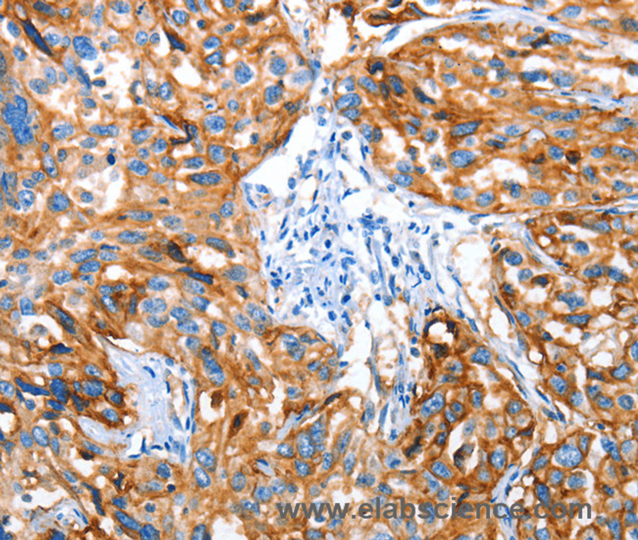 Immunohistochemistry of paraffin-embedded Human esophagus cancer using AOX1 Polyclonal Antibody at dilution of 1:65