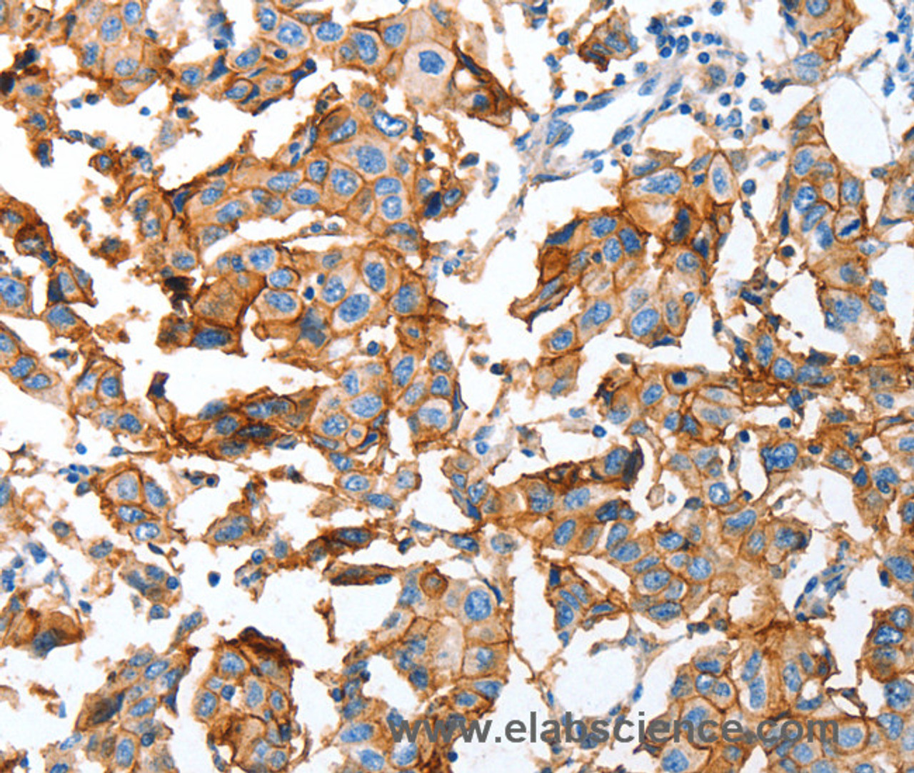 Immunohistochemistry of paraffin-embedded Human breast cancer using AOX1 Polyclonal Antibody at dilution of 1:65