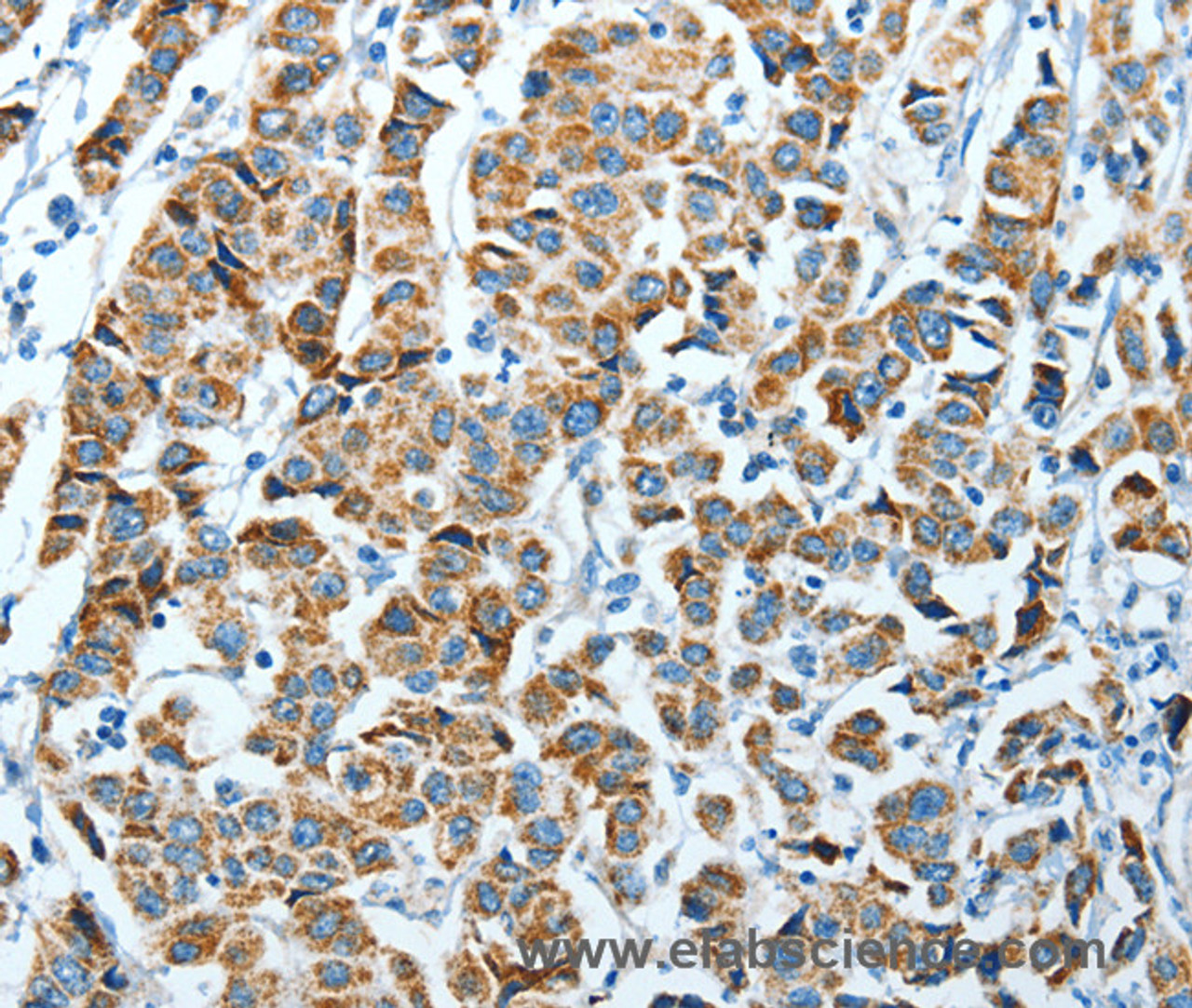 Immunohistochemistry of paraffin-embedded Human breast cancer using ALDH4A1 Polyclonal Antibody at dilution of 1:45