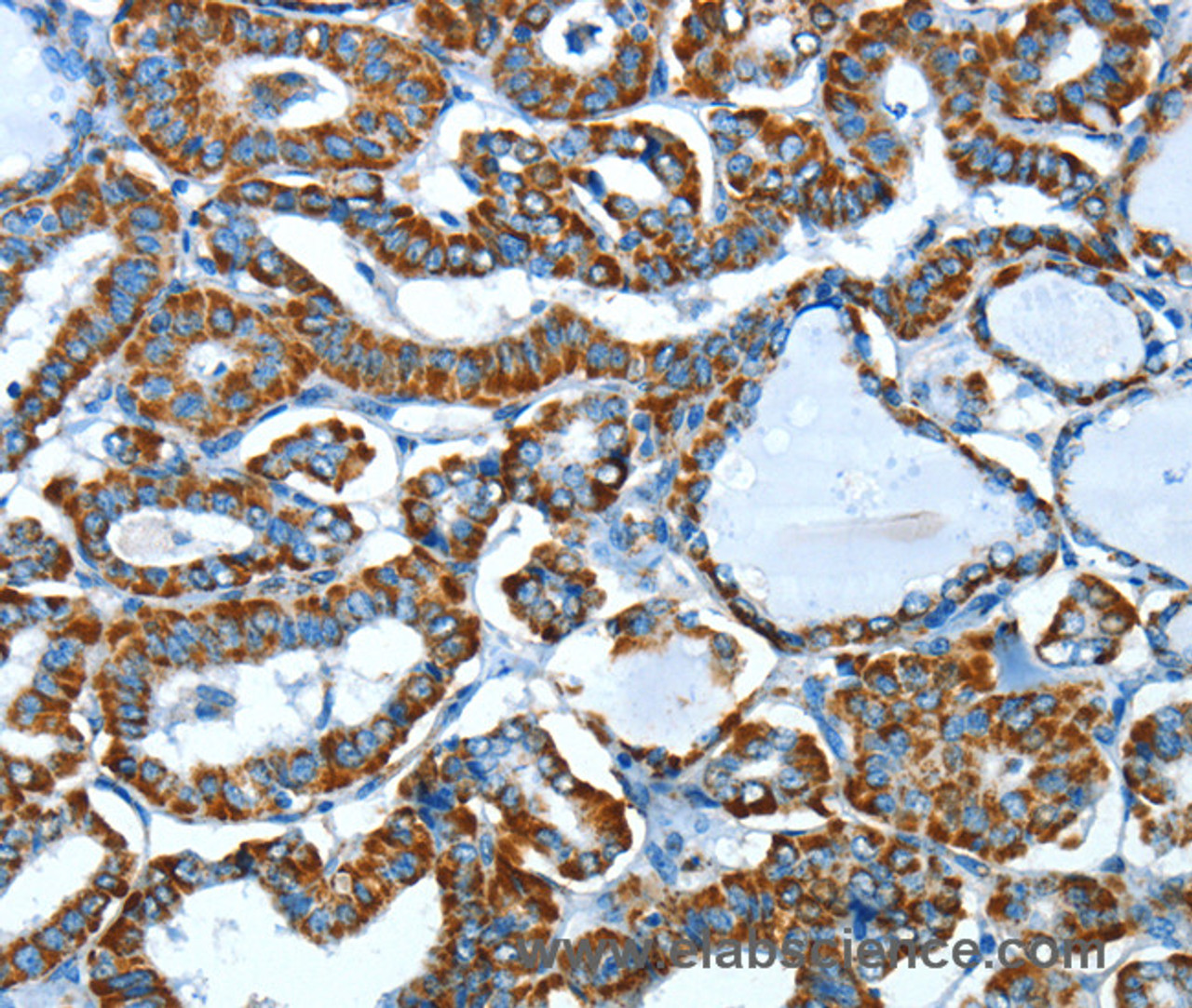 Immunohistochemistry of paraffin-embedded Human thyroid cancer using ALDH6A1 Polyclonal Antibody at dilution of 1:45