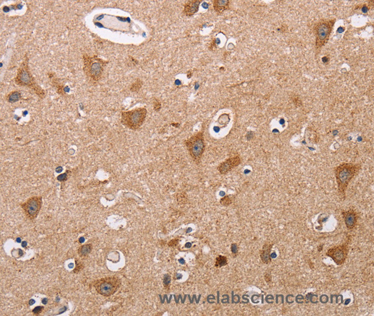 Immunohistochemistry of paraffin-embedded Human thyroid cancer tissue using ALG9 Polyclonal Antibody at dilution 1:60