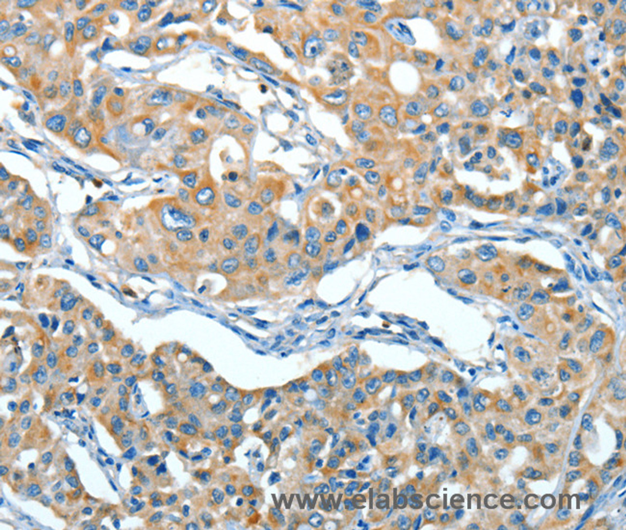 Immunohistochemistry of paraffin-embedded Human lung cancer tissue using SERPINA3 Polyclonal Antibody at dilution 1:55