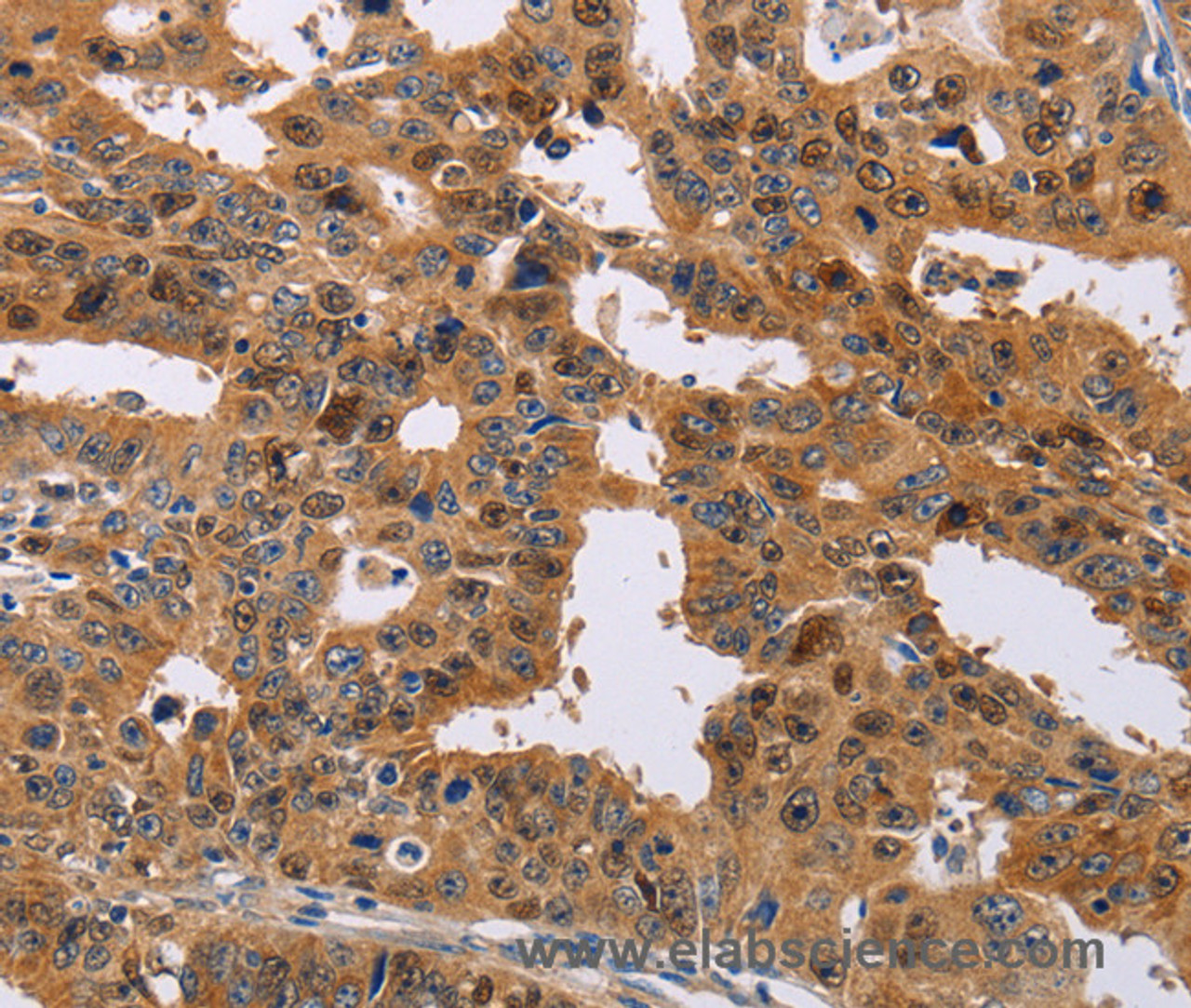 Immunohistochemistry of paraffin-embedded Human gasrtic cancer tissue using NIF3L1 Polyclonal Antibody at dilution 1:30