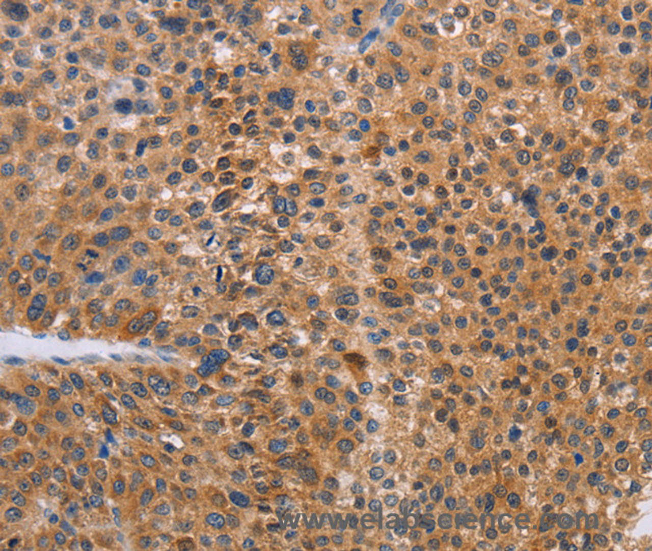 Immunohistochemistry of paraffin-embedded Human liver cancer tissue using NIF3L1 Polyclonal Antibody at dilution 1:30