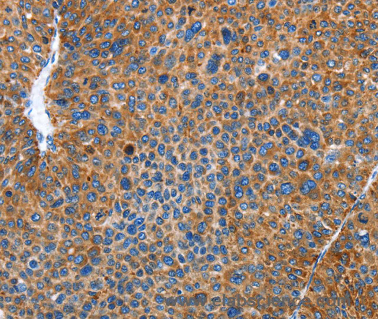 Immunohistochemistry of paraffin-embedded Human liver cancer using AUP1 Polyclonal Antibody at dilution of 1:50