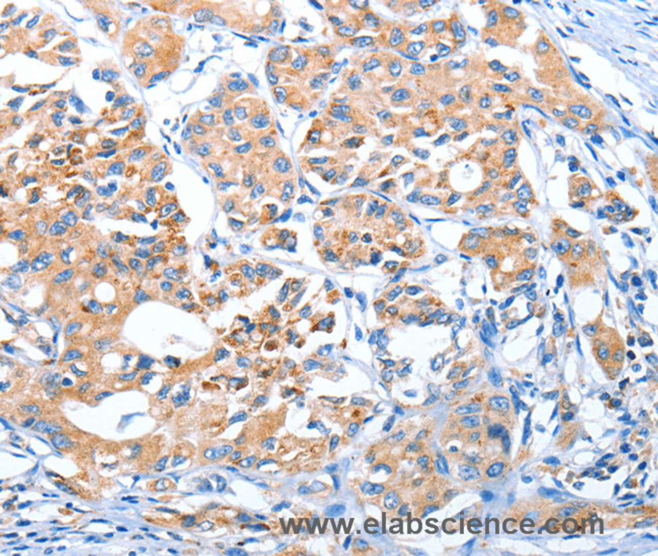 Immunohistochemistry of paraffin-embedded Human lung cancer using AUP1 Polyclonal Antibody at dilution of 1:50