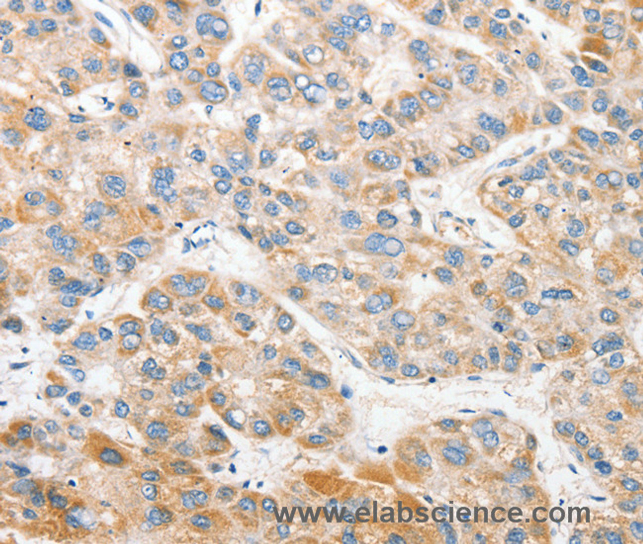 Immunohistochemistry of paraffin-embedded Human liver cancer tissue using ANAPC2 Polyclonal Antibody at dilution 1:30