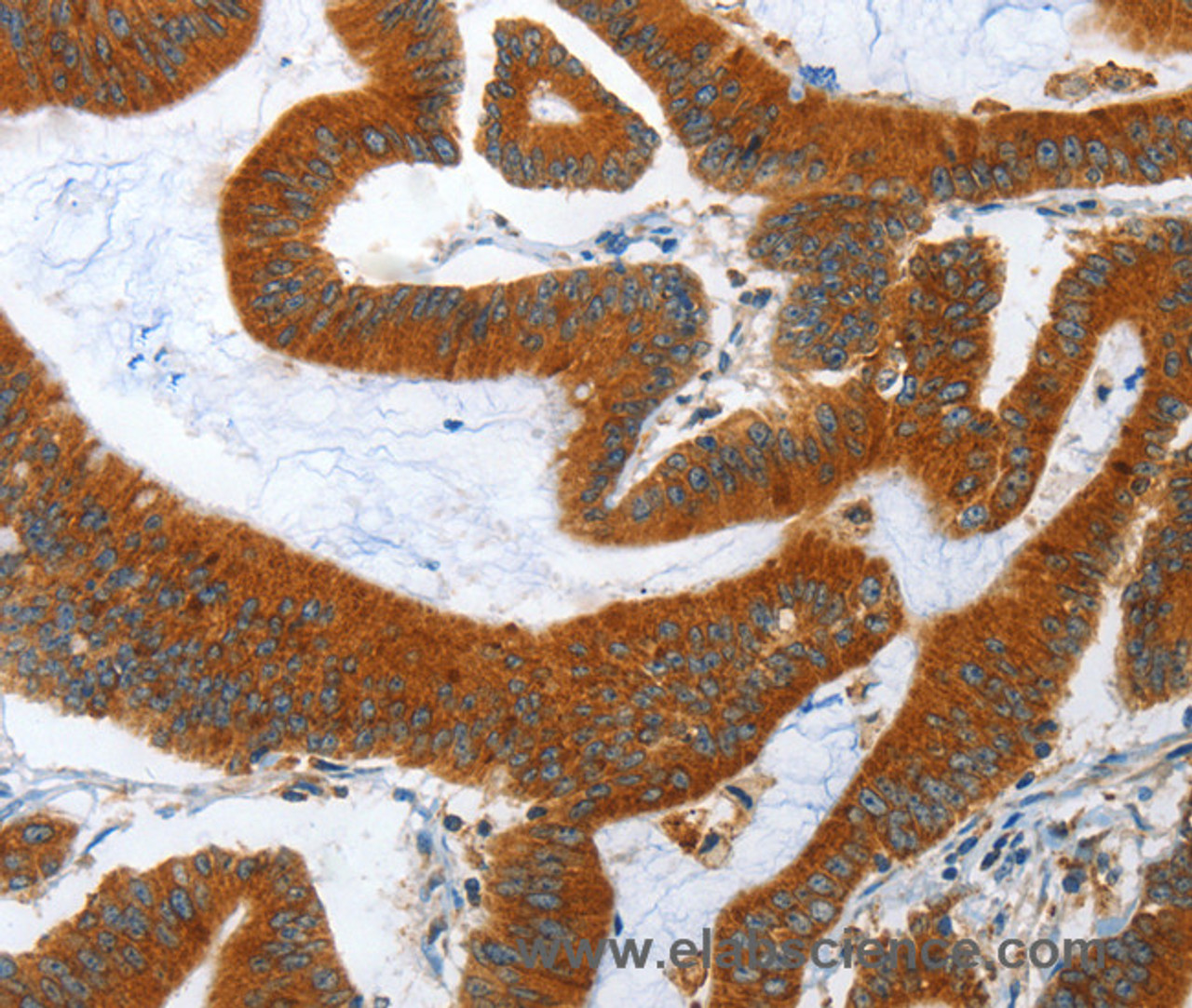 Immunohistochemistry of paraffin-embedded Human colon cancer tissue using ANAPC10 Polyclonal Antibody at dilution 1:40
