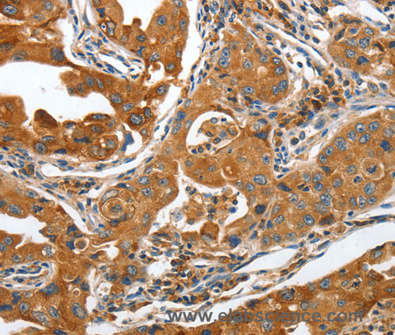 Immunohistochemistry of paraffin-embedded Human lung cancer tissue using ANAPC10 Polyclonal Antibody at dilution 1:40