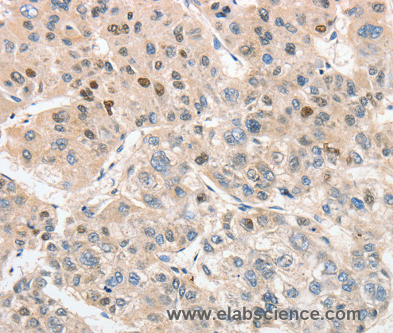 Immunohistochemistry of paraffin-embedded Human liver cancer tissue using APC5 Polyclonal Antibody at dilution 1:30
