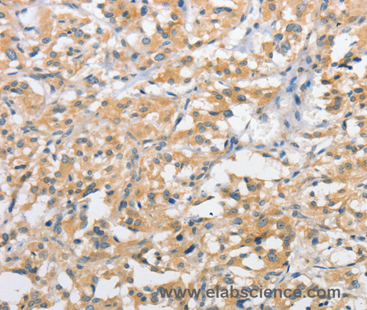 Immunohistochemistry of paraffin-embedded Human thyroid cancer using ATG10 Polyclonal Antibody at dilution of 1:60