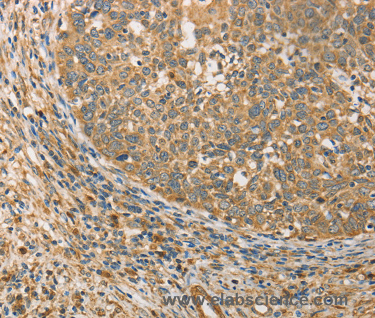 Immunohistochemistry of paraffin-embedded Human cervical cancer tissue using ATG3 Polyclonal Antibody at dilution 1:40