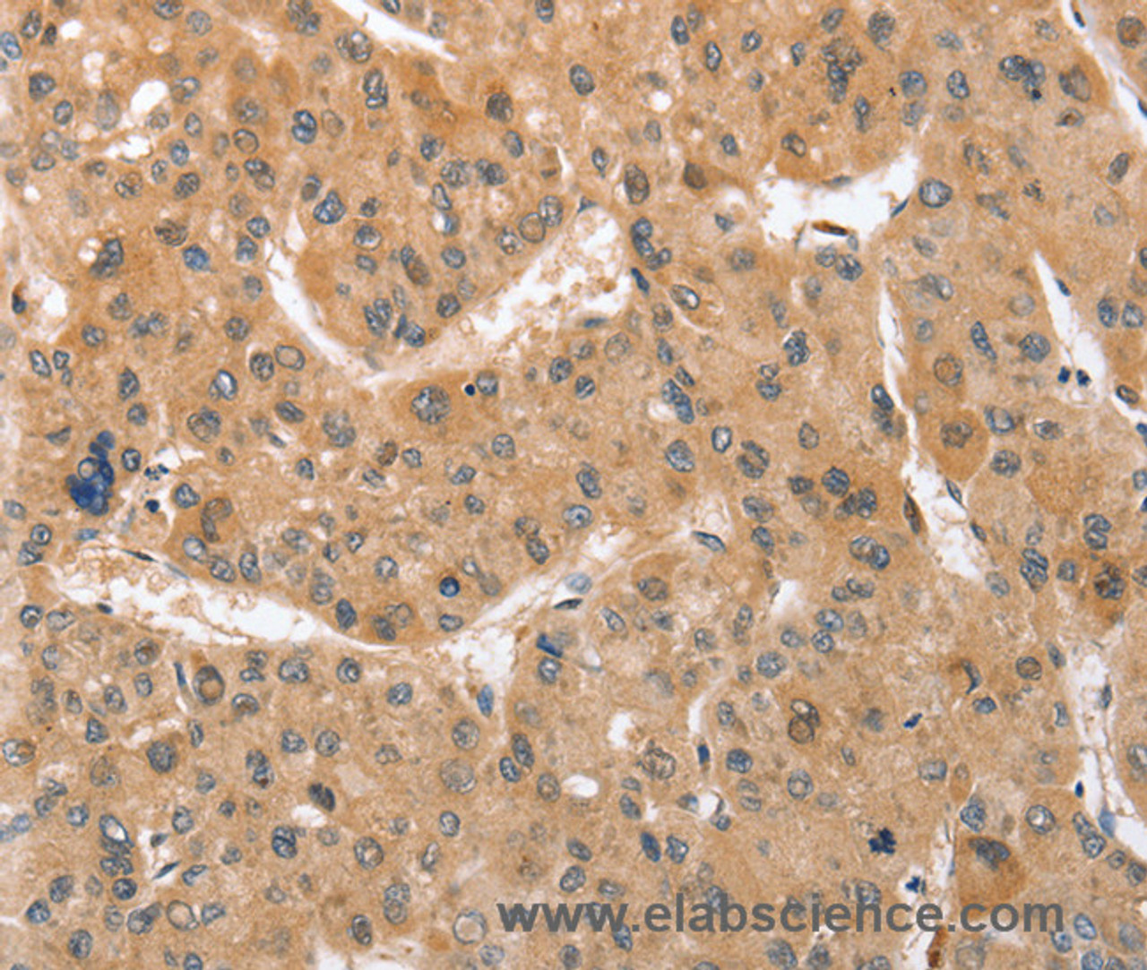 Immunohistochemistry of paraffin-embedded Human liver cancer tissue using ATG12 Polyclonal Antibody at dilution 1:70