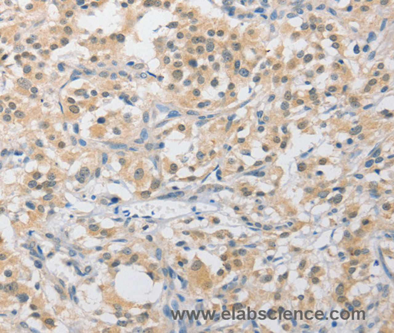 Immunohistochemistry of paraffin-embedded Human thyroid cancer tissue using APLF Polyclonal Antibody at dilution 1:40