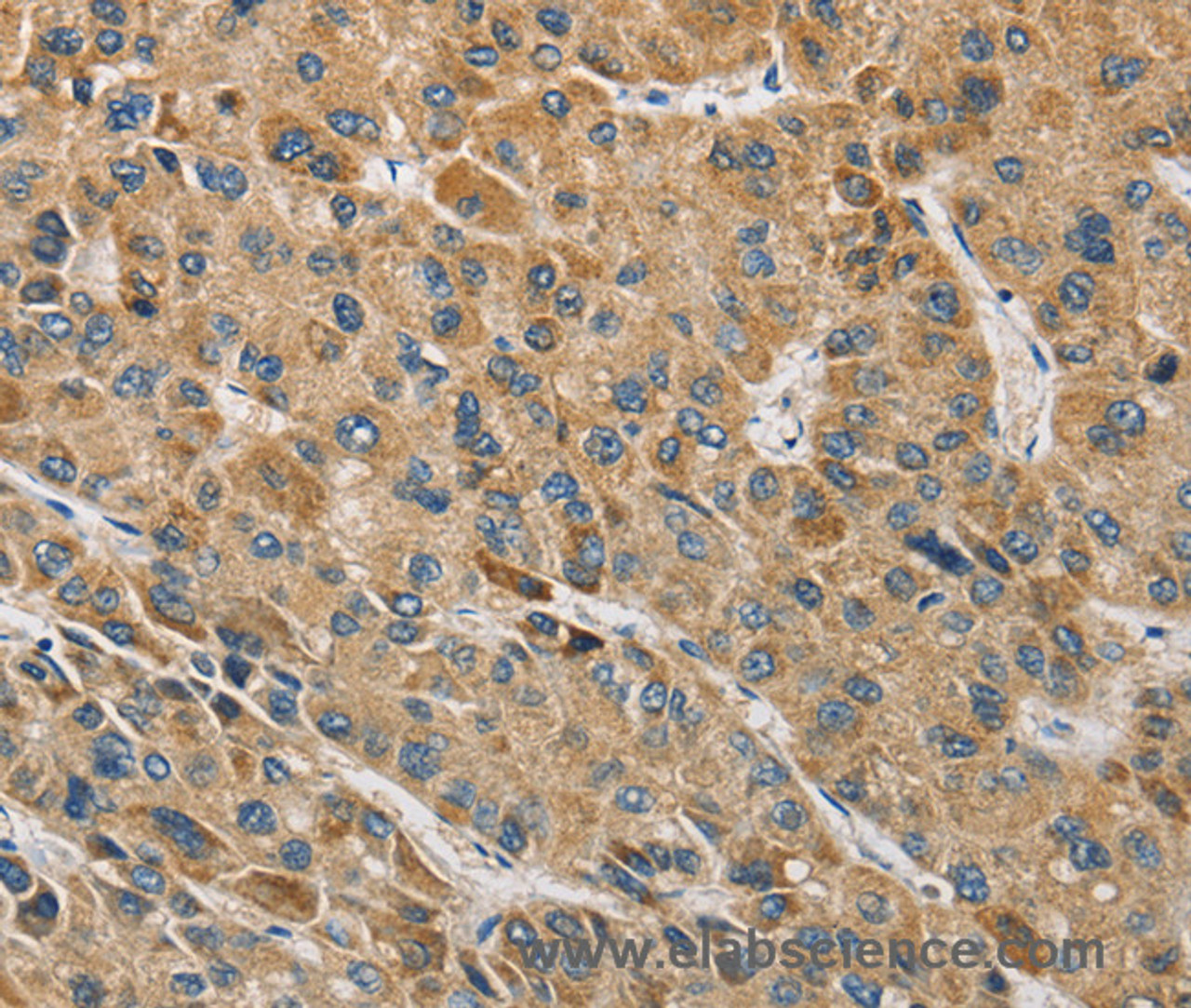 Immunohistochemistry of paraffin-embedded Human liver cancer tissue using MIP Polyclonal Antibody at dilution 1:60