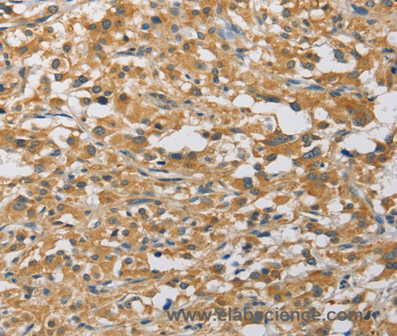 Immunohistochemistry of paraffin-embedded Human thyroid cancer tissue using MIP Polyclonal Antibody at dilution 1:60