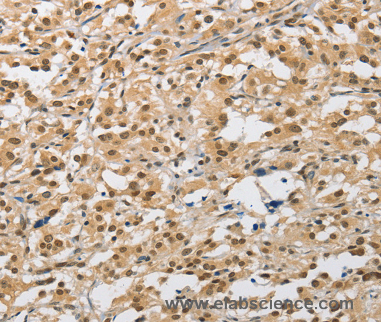Immunohistochemistry of paraffin-embedded Human thyroid cancer tissue using AMZ2 Polyclonal Antibody at dilution 1:40