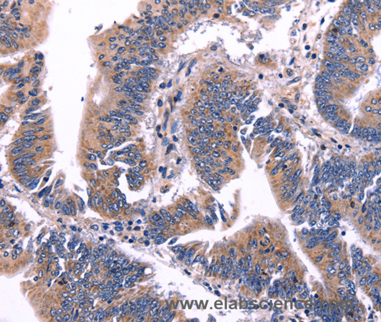 Immunohistochemistry of paraffin-embedded Human colon cancer tissue using ARC Polyclonal Antibody at dilution 1:50