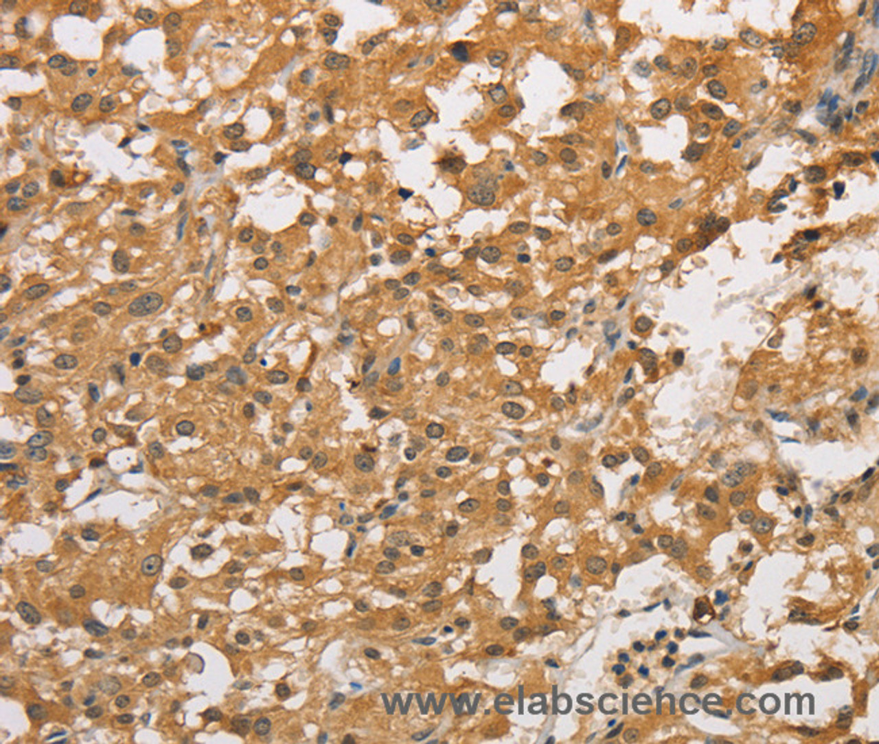 Immunohistochemistry of paraffin-embedded Human thyroid cancer using ARHGEF5 Polyclonal Antibody at dilution of 1:50