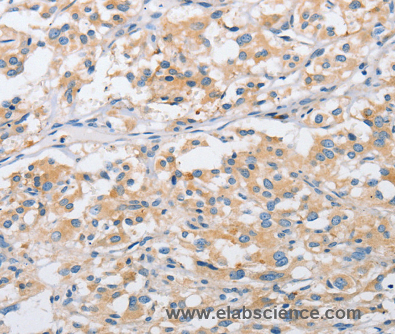 Immunohistochemistry of paraffin-embedded Human thyroid cancer tissue using ARHGEF9 Polyclonal Antibody at dilution 1:50